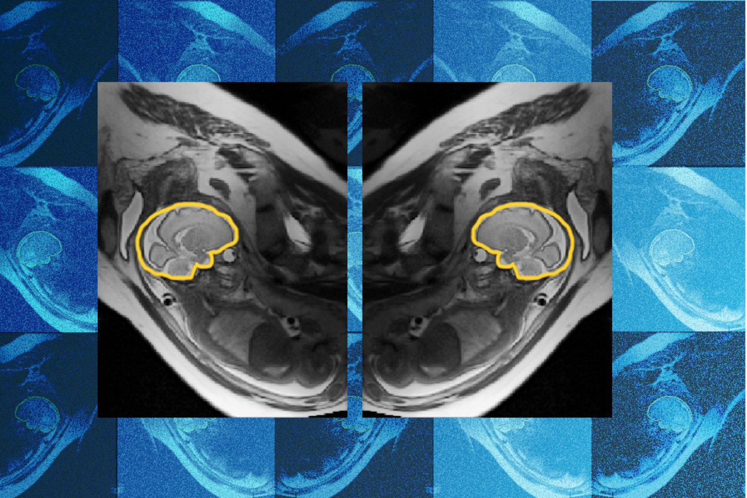 Why teaching AI about symmetry could make prenatal diagnosis more reliable | MIT News